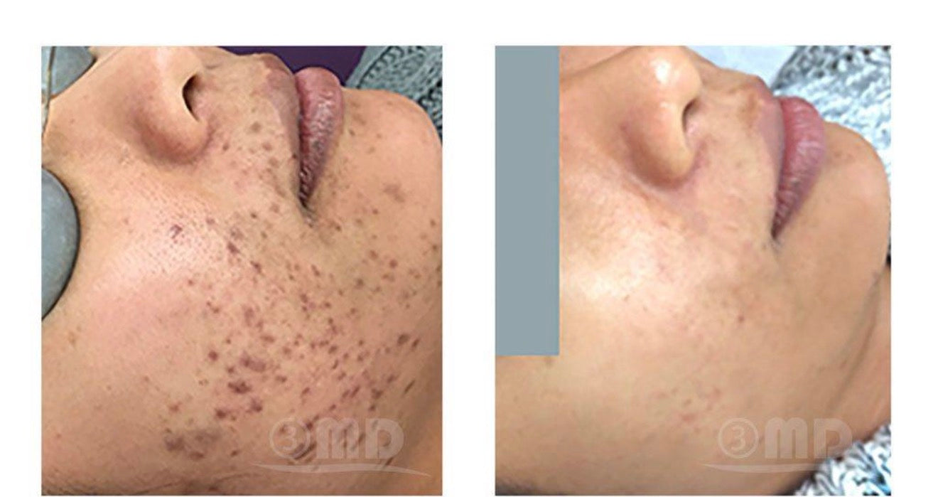 SÉRUM ANUA- NIACINAMIDE 10 + TXA 4