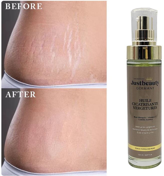 ✨ Duo Anti-Vergetures – Peau lisse, ferme & réparée